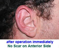 plastic-surgery-prominent-ear 